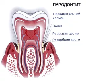 Пародонтит