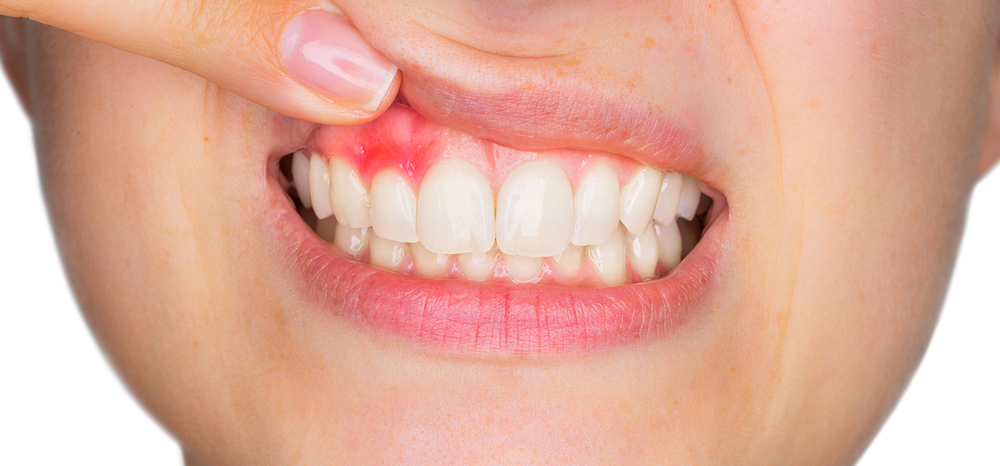 picture2_-gingivit-praktic_347151_p0.png