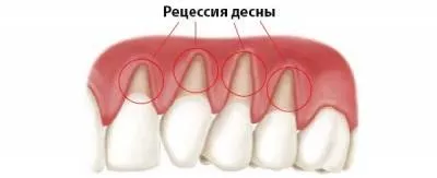 Рецессия десны
