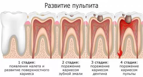 стадии развития пульпита