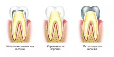 виды коронок