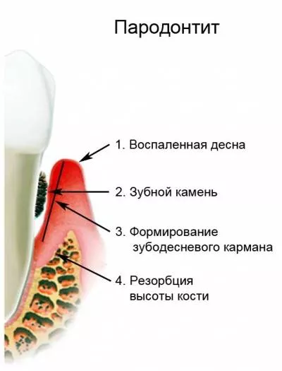 пародонтит